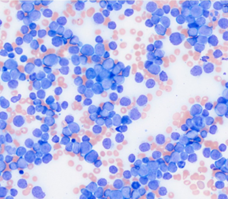 Peripheral Blood Film Abnormalities